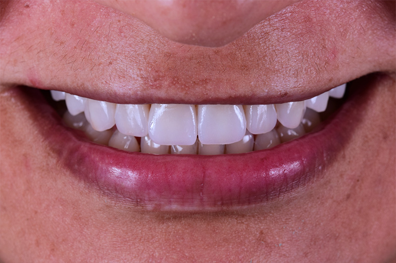 fabio-persegani-lentes-de-contato-dental-02